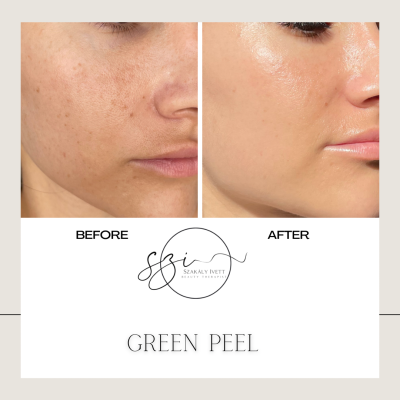 green-peel-1